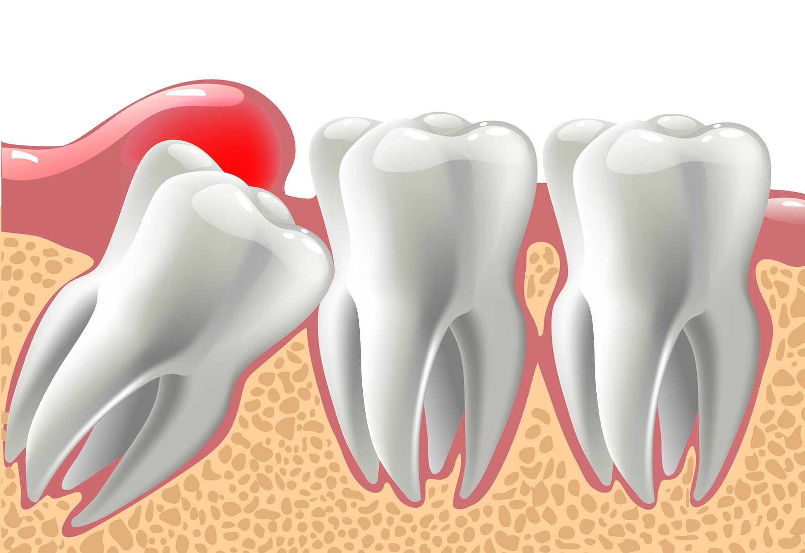 Wisdom Tooth Extraction